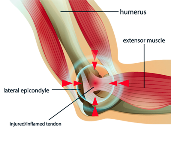 Vida Spine Tennis Elbow