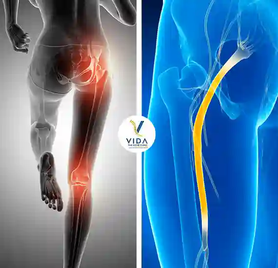 Sciatica Nerve Pain